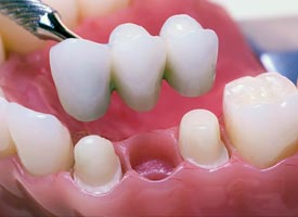 dental-bridges