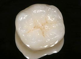 Dental Crowns