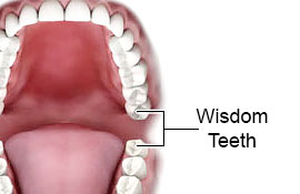 Tooth Extractions