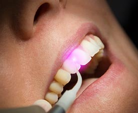 laser-dentistry