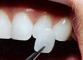 Porcelain Veneers