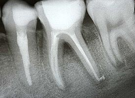 Root Canal Treatment