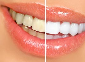 Teeth Whitening