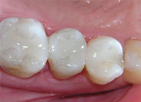 White (Tooth Colored) Fillings